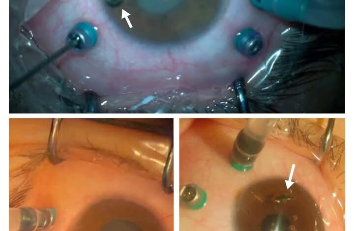 أطباء العيون بمستشفي كفر الشيخ الجامعي نجحوا في إنقاذ ثلاث حالات من فقدان البصر 1 IMG 20250525 WA0036